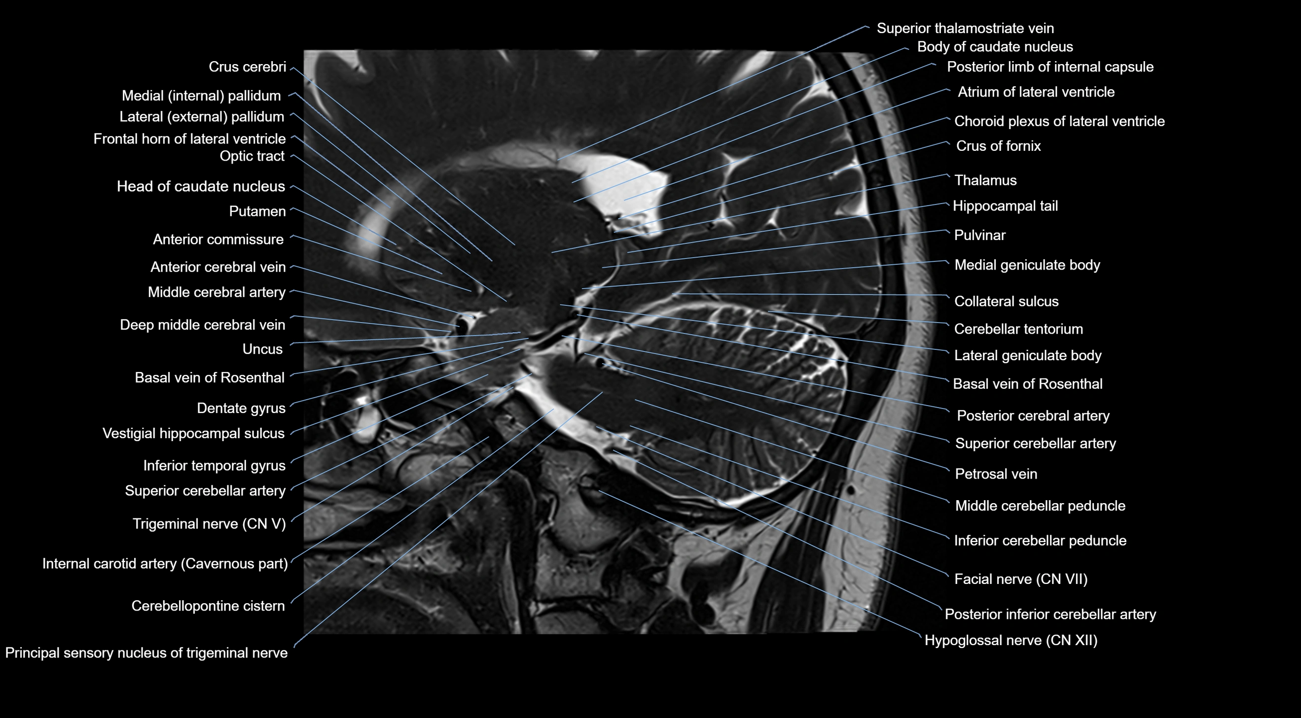 MRI brainstem & basal ganglia anatomy labelled  3T MRI images -img-10001-00017.webp